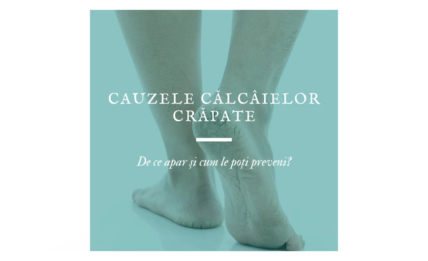 Cauzele călcâielor crăpate: de ce apar și cum le poți preveni